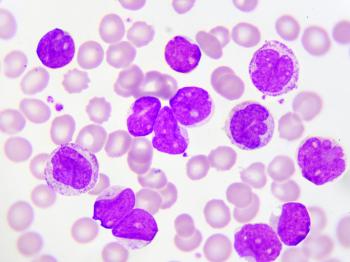 leukemia-cells